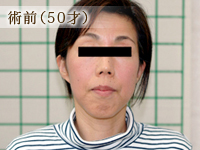 術前（50才）