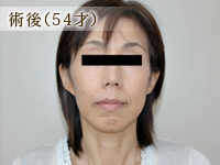 術後（54才）