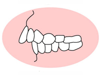 奥歯の高さに問題があると……